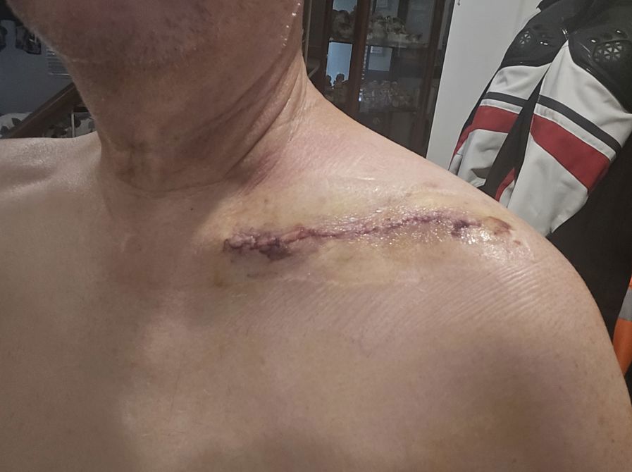 Surgery recovery is slow going