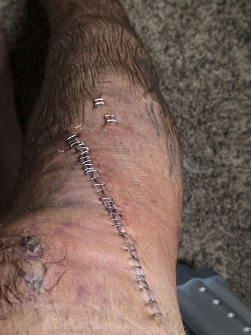 After Surgery